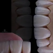 CORONA EMAX ESTRATIFICADO